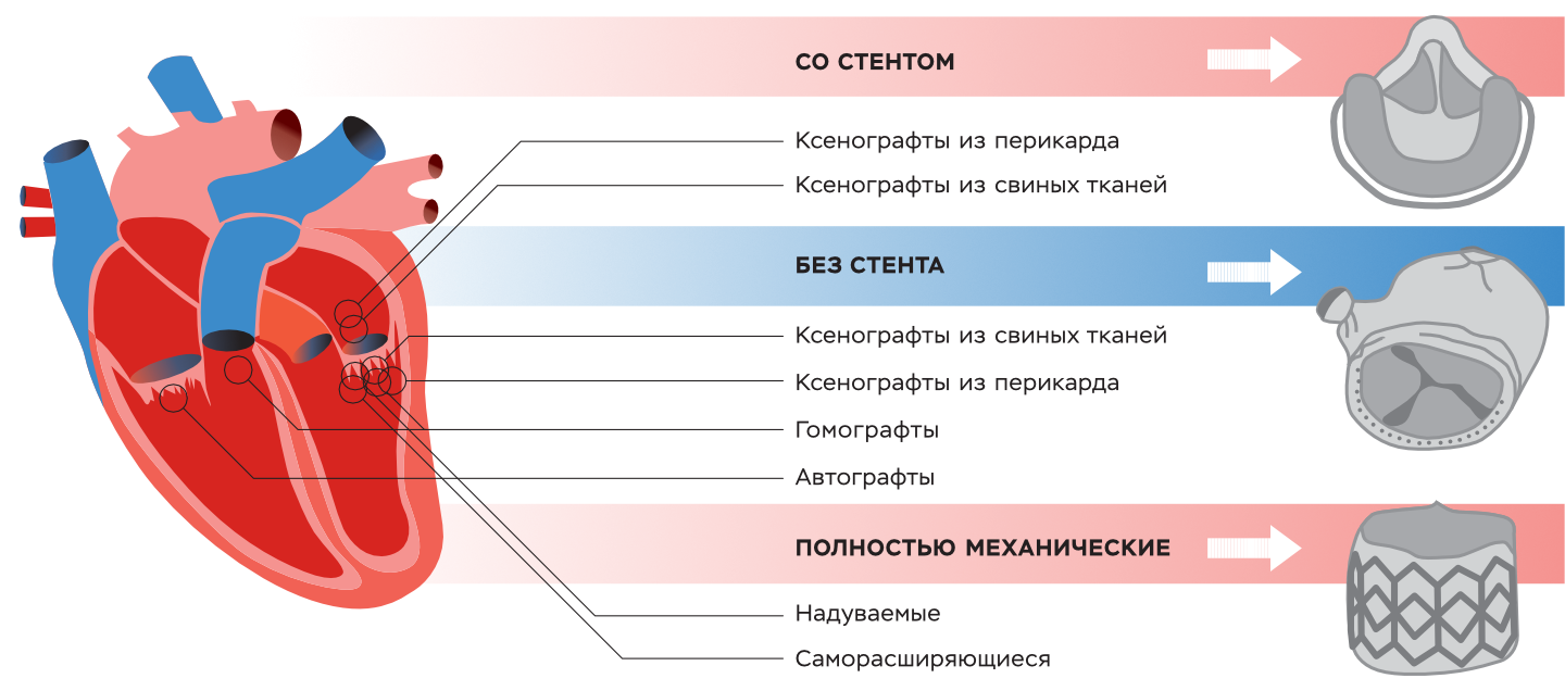 Три основных типа протезов сердечных клапанов